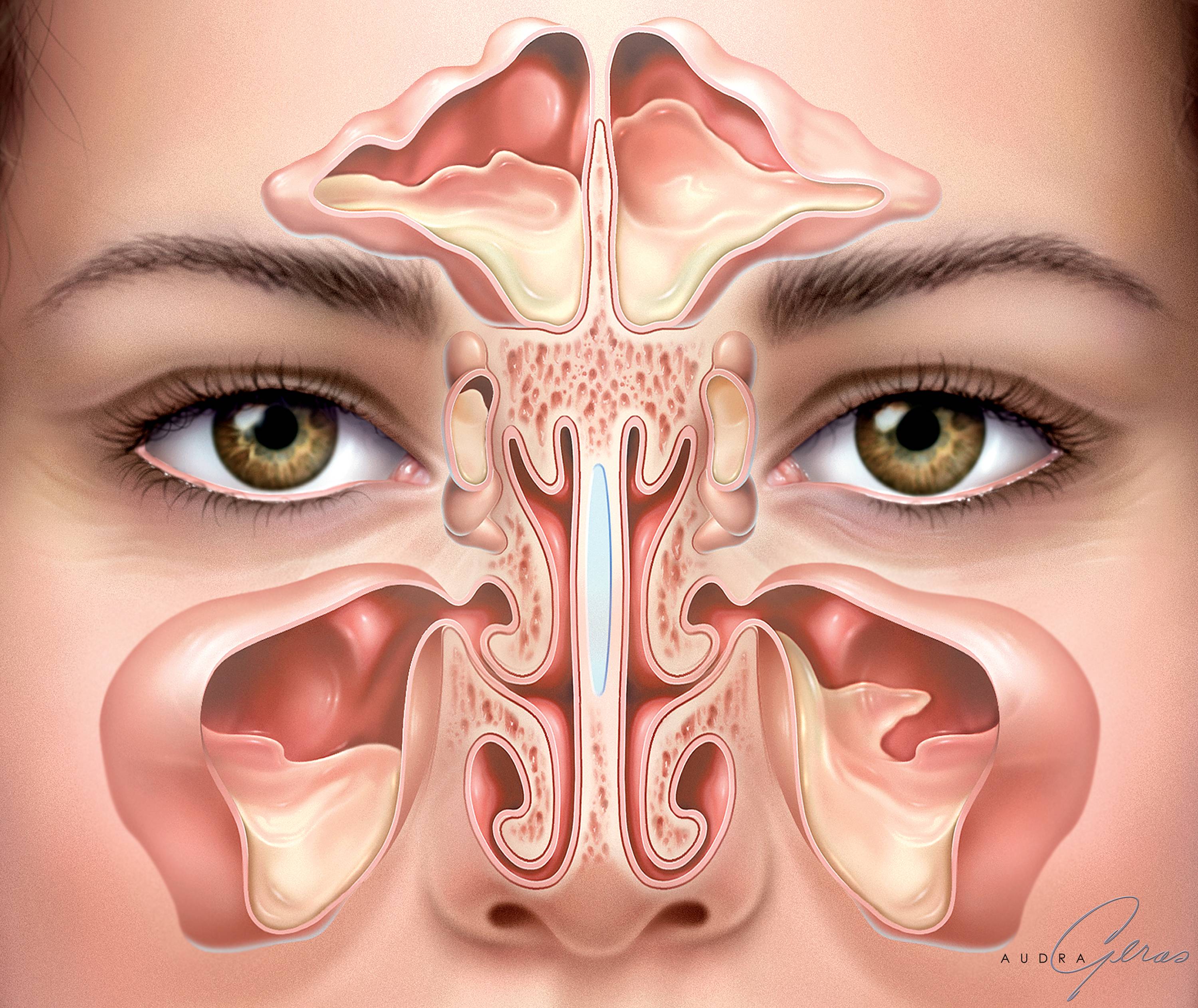 Синусит: симптомы и лечение у взрослых, описание болезни и рекомендации, какой использовать спрей для носа от синусита
