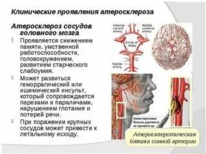 Лечение атеросклероза сосудов головного мозга