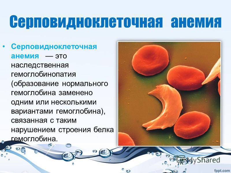 Серповидно-клеточная анемия. причины, симптомы, диагностика и лечение серповидно-клеточной анемии.