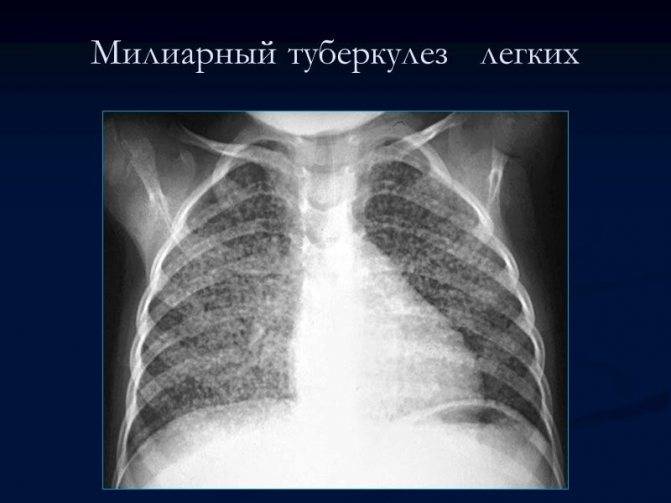 Симптомы детского туберкулеза