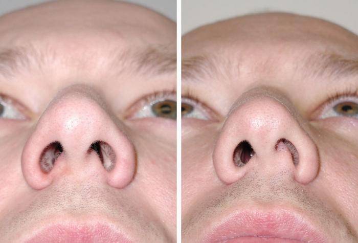 Эффективное лечение полипов в носу чистотелом - лортут