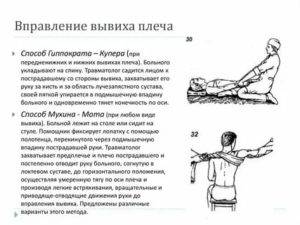 Реабилитация при вывихах плеча клинические рекомендации рф россия medelement