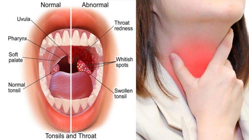 Болит горло с одной стороны - опасно ли это и что делать