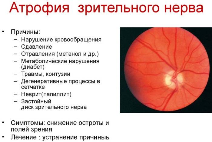 Атрофия зрительного нерва: методы лечения - "здоровое око"