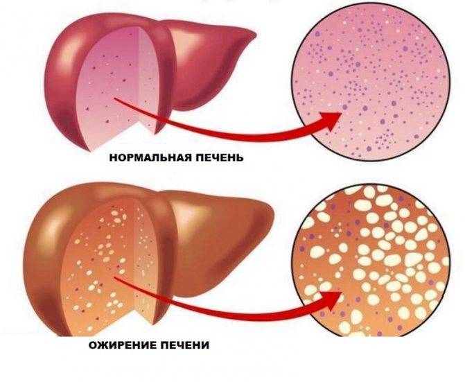 Как лечить жировой гепатоз печени народными средствами и медикаментами