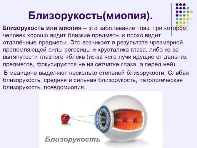 Миопия (близорукость) 1 степени (слабой) - "здоровое око"
