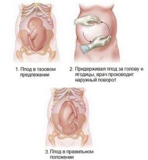 Чем опасна клебсиелла пневмония при беременности