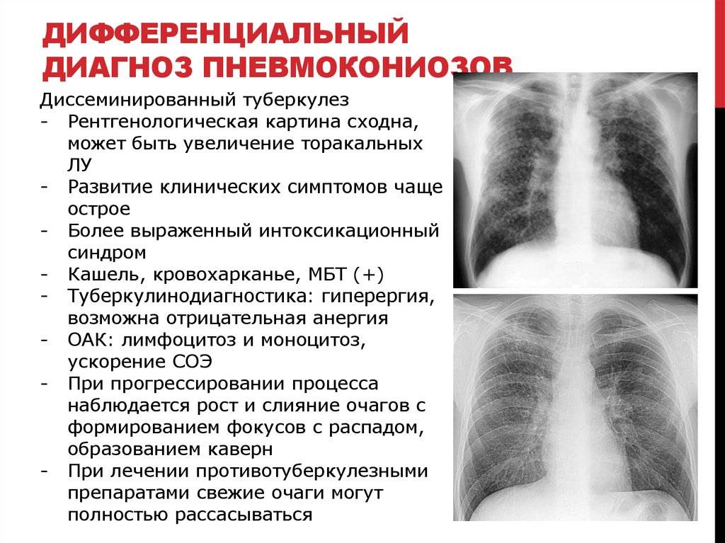 Диссеминированный туберкулез легких - дифференциальная диагностика