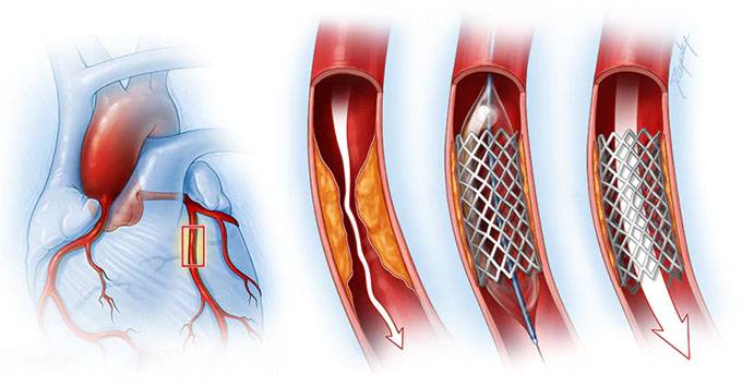 Стентирование сосудов сердца — показания и эффективность процедуры