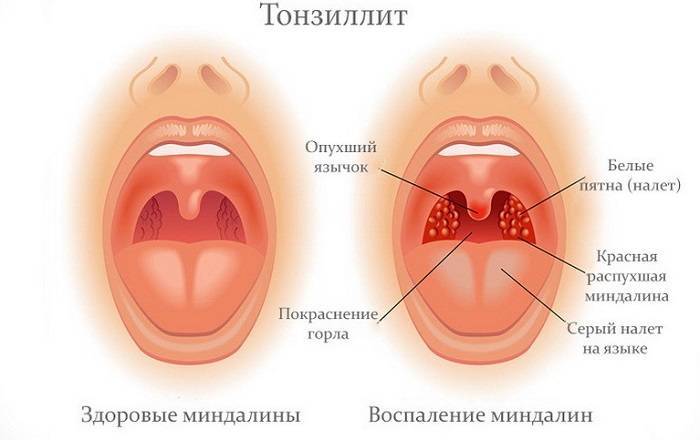 Тонзиллит горла у детей лечение