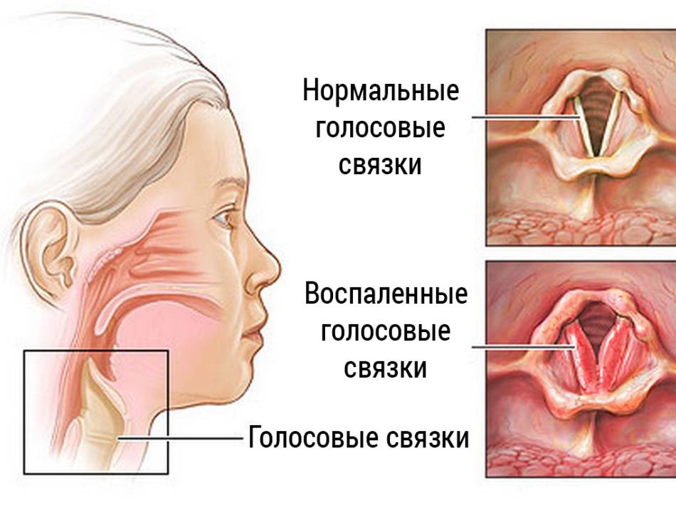 Щекочет в горле: причины щекотания с кашлем и без, лечение