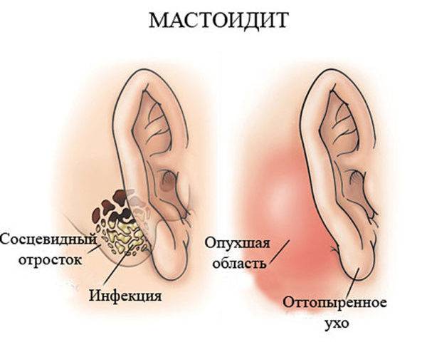 Воспаление височной кости симптомы - wikisekurs.ru