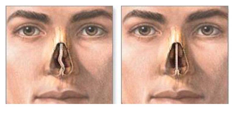 Деформация носовой перегородки мкб 10. перфорация носовой перегородки: причины, симптомы, методы лечения