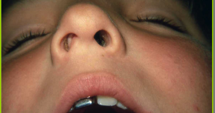 У ребенка полипы в носу (32 фото): что это, симптомы и лечение, что делать при полипах в пищеводе или матке у девочки-подростка