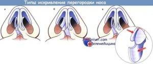 Деформация носовой перегородки мкб 10. перфорация носовой перегородки: причины, симптомы, методы лечения