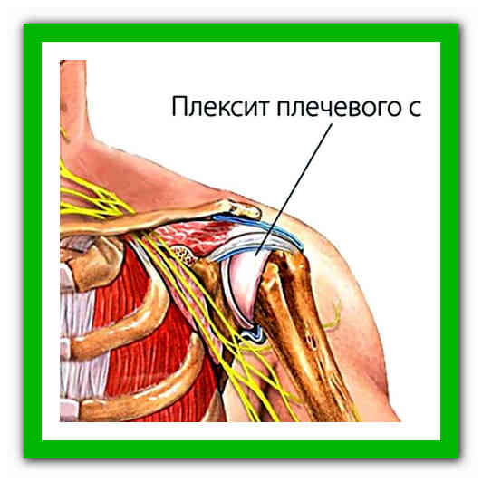 Классификация, причины, симптомы и методы лечения плексита плечевого сустава