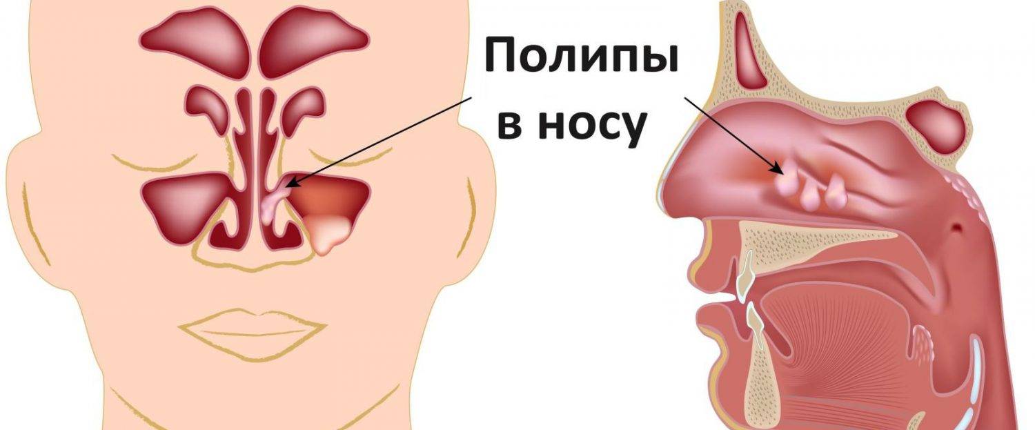 Полипы в носу: способы лечения без операции