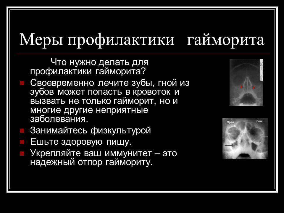 Презентация гайморит лечение