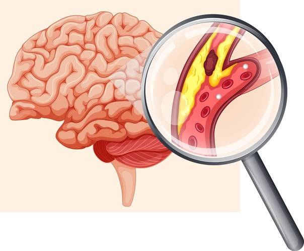 Атеросклероз сосудов головного мозга: причины, симптомы, лечение