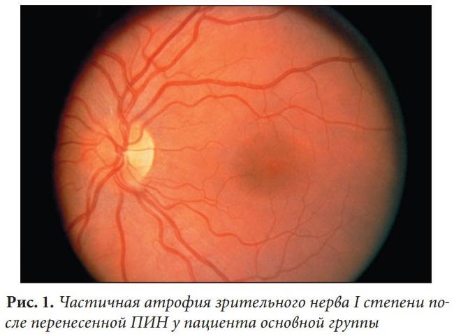 Атрофия зрительного нерва (полная и частичная): что это такое, симптомы, лечение | rvdku.ru