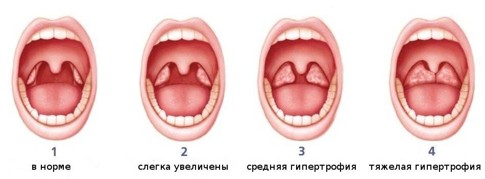Аденоиды у взрослых: симптомы и лечение pulmono.ru
аденоиды у взрослых: симптомы и лечение