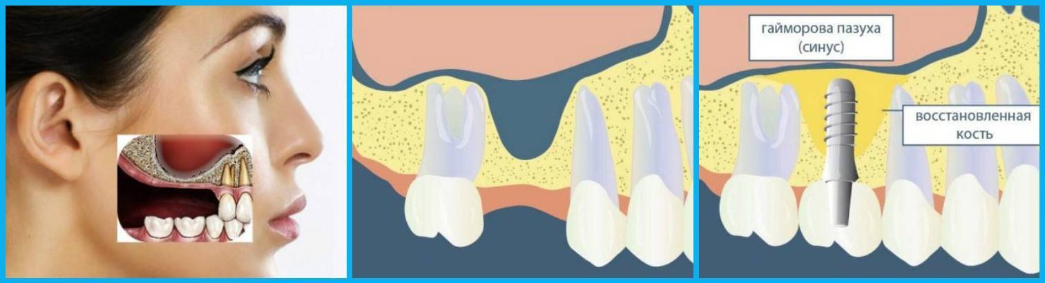 Синус-лифтинг в стоматологии: рекомендации и противопоказания