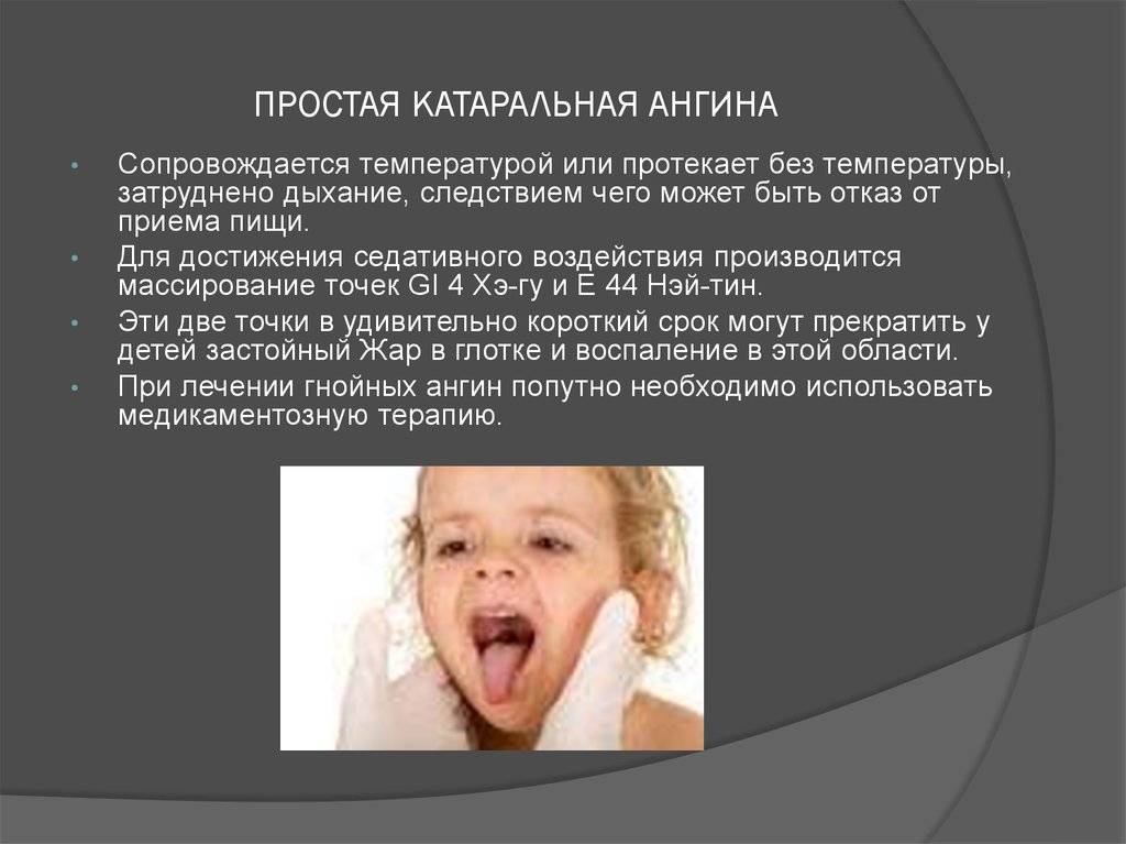 Катаральная ангина: фото горла с признаками катаральной ангины, как лечить заболевание у взрослых