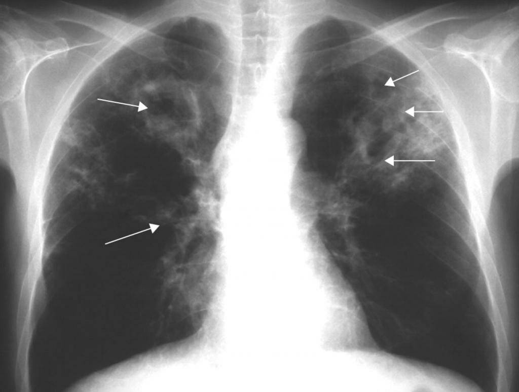 Очаговый туберкулез легких – симптомы, заразен или нет для окружающих