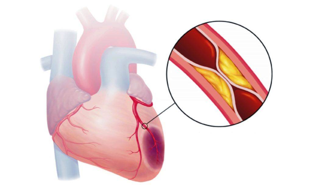 Что такое атеросклеротический кардиосклероз сердца и его лечение