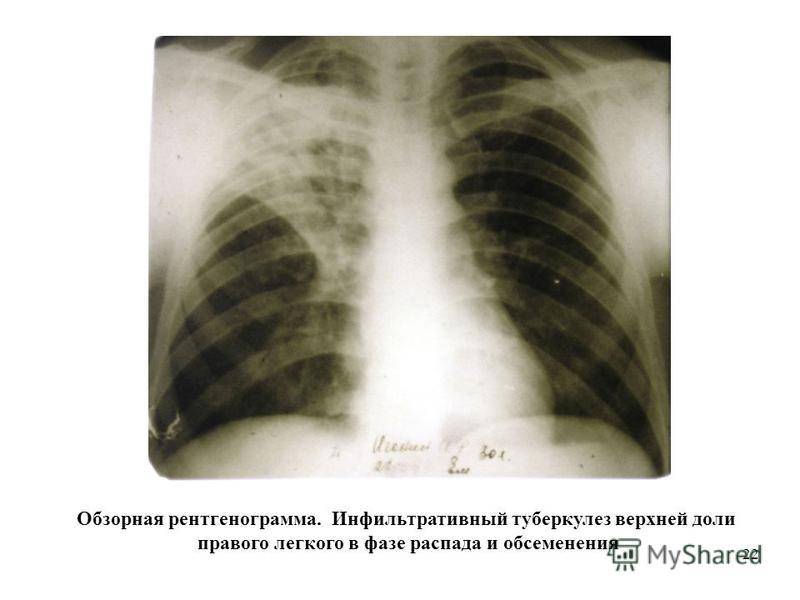 Фазы (стадии), симптомы, лечение и заразность инфильтративного туберкулеза легких с распадом и без