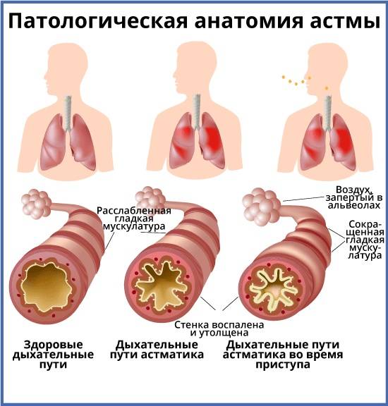 Формы бронхиальной астмы: о чем нужно знать больным?