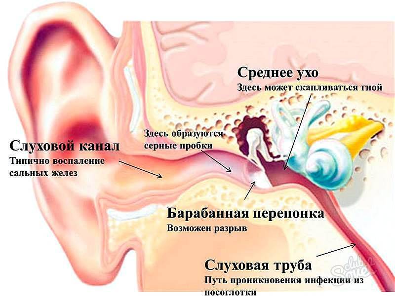 Как и чем вылечить отит уха в домашних условиях