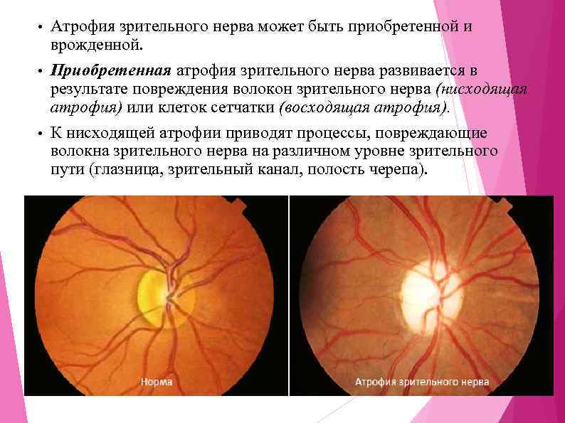 Причины и лечение атрофии зрительного нерва