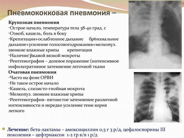 Какой кашель при пневмонии у детей и взрослых, как с ним бороться pulmono.ru
какой кашель при пневмонии у детей и взрослых, как с ним бороться