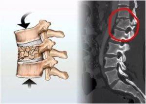 Перелом шеи: симптомы травмы шейных позвонков | perelomkocti.ru