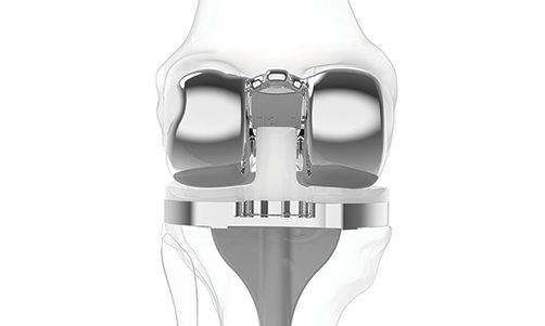Современные эндопротезы коленного сустава — виды протезов колена, особенности, цена