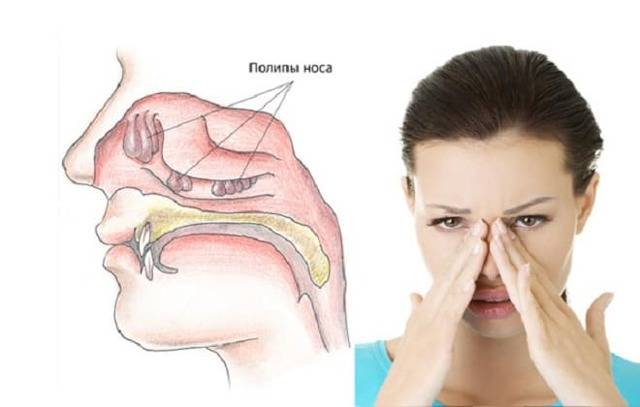 Полипы в носу: симптомы и лечение. причины и методы терапии