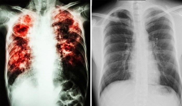 Причины и симптомы туберкулеза легких