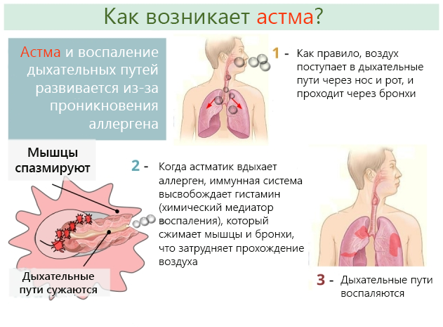 Можно ли вылечить бронхиальную астму навсегда? | астманиа