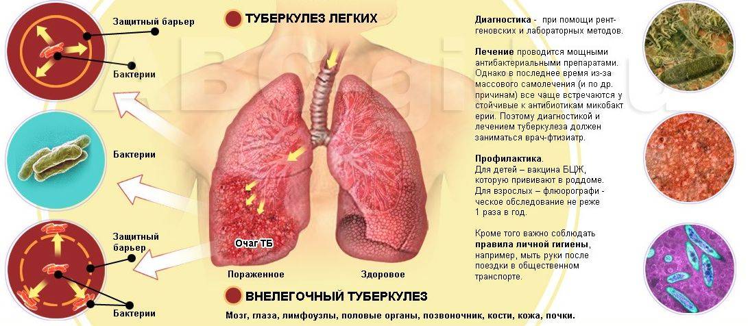 Лечение туберкулеза в домашних условиях - лечениевед