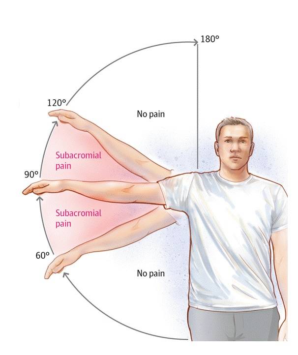 Симптомы, диагностика и лечение субакромиального бурсита плечевого сустава