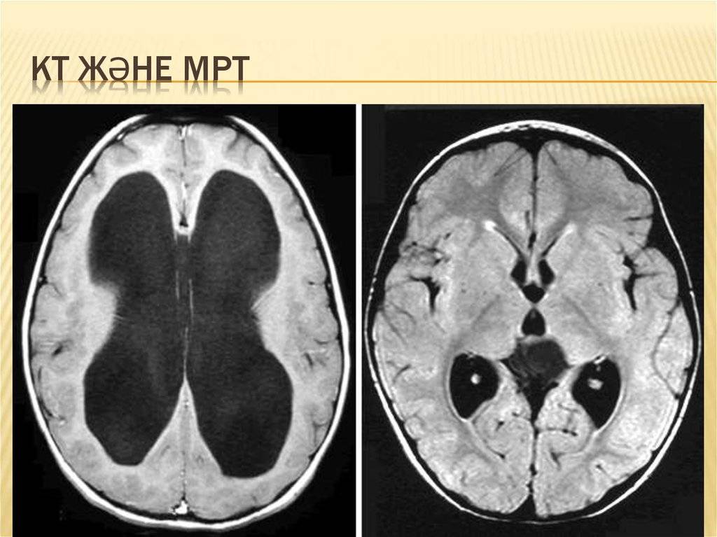 Умеренная наружная гидроцефалия головного мозга: причины, лечение