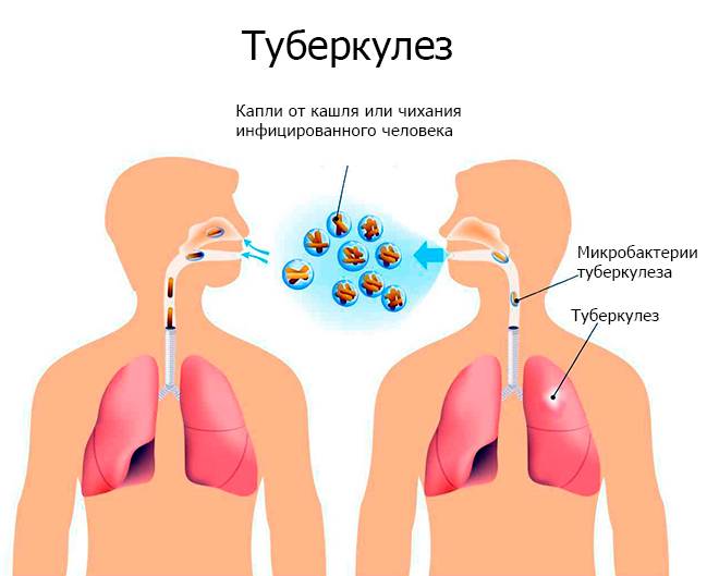 Как передается туберкулез от человека к человеку: симптомы и первые признаки