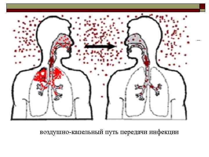 Хламидийная пневмония заразна или нет