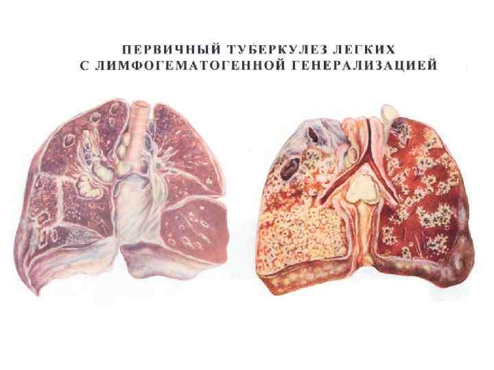Осложнения и последствия туберкулеза легких у мужчин и у женщин