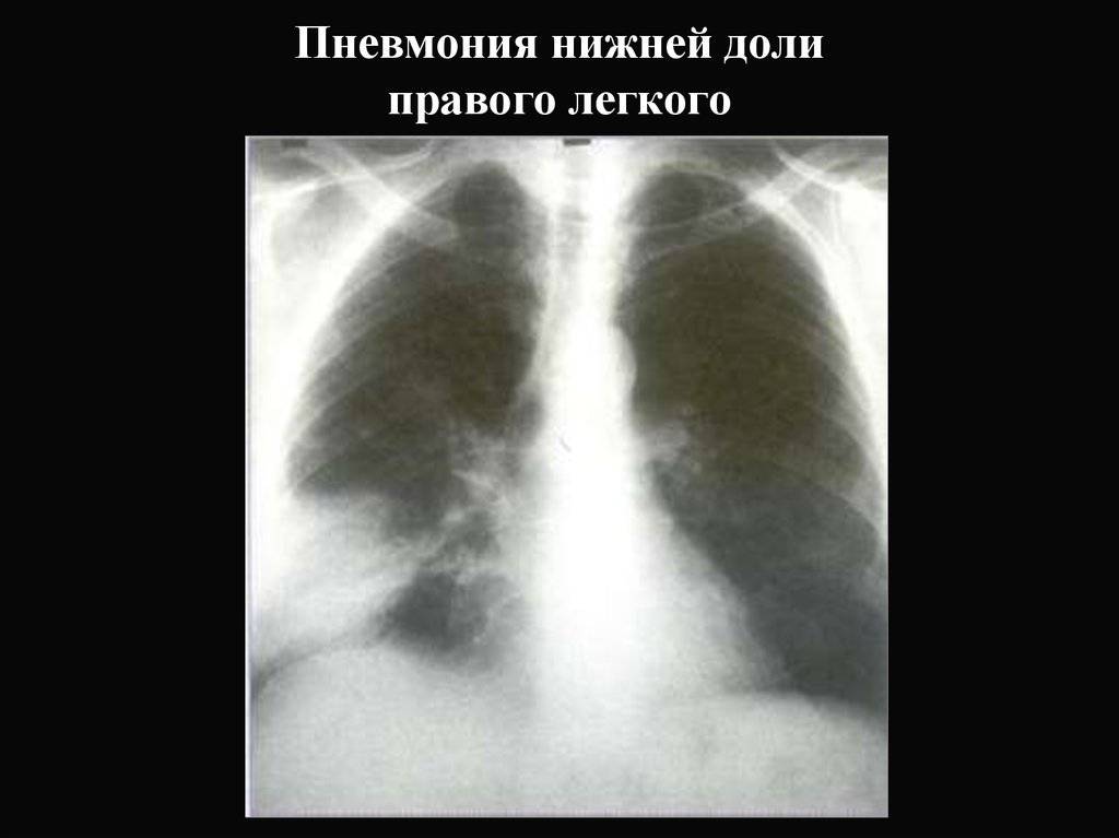 Двухсторонняя нижнедолевая пневмония: особенности течения и лечение