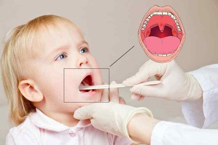Острый тонзиллит у ребёнка: симптомы, лечение и профилактика