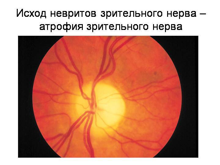 Атрофия зрительного нерва: лечение, симптомы, причины полного или частичного поражение