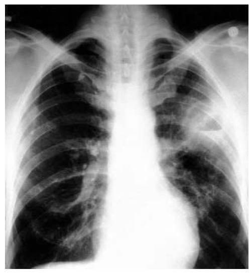 Абсцедирующая пневмония - признаки, причины, симптомы, лечение и профилактика - idoctor.kz