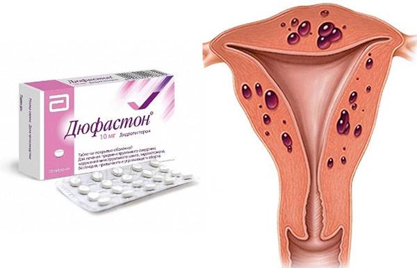 Симптомы аденомиоза матки при климаксе у женщин: диагностика и лечение